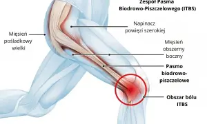 Anatomia kolana z zaznaczonym pasmem biodrowo-piszczelowym, obszarem bólu ITBS i mięśniami.