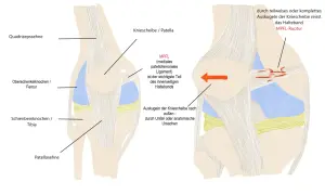 Anatomische Darstellung eines Knies, die zeigt, wie das MPFL-Band bei einer Ausrenkung der Kniescheibe reißen kann (MPFL-Ruptur).