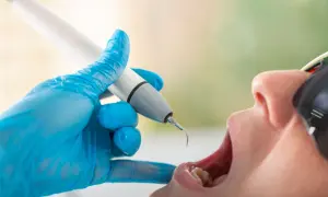 Dentysta usuwa kamień z zębów pacjenta. Czy usuwanie kamienia boli? Nowoczesne metody są zazwyczaj bezbolesne.