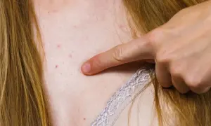 Palec wskazuje na zaczerwienione krostki i wypryski, które tworzą trądzik na dekolcie.