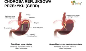 Ilustracja pokazuje prawidłowe i nieprawidłowe działanie zwieracza przełyku, wyjaśniając problem refluksu żołądka.