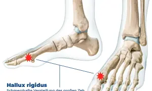 Anatomische Darstellung des Fußskeletts mit Hervorhebung des Gelenks am großen Zeh, das von Hallux rigidus betroffen ist.