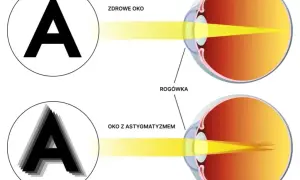 Astygmatyzm a soczewki sferyczne? Poznaj prawdę i rozwiązanie