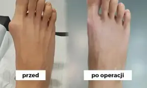 Jak długo boli po operacji haluksa? Pełen przewodnik rekonwalescencji