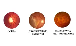 Trzy obrazy dna oka: jaskra, odwarstwienie siatkówki i makulopatia krótkowzroczna.