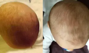 Head Care: Po jakim czasie poduszka skoryguje spłaszczoną główkę?