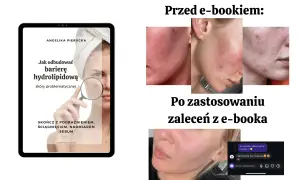 Skuteczne sposoby na czerwone plamy po pryszczach i ich redukcję
