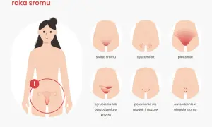 Ilustracja pokazuje wczesne objawy raka sromu: świąd, dyskomfort, pieczenie, zgrubienia, grudki i owrzodzenia.