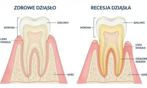 Porównanie zdrowych dziąseł i recesji. Dowiedz się, jak wzmocnić zęby i dziąsła, by uniknąć odsłonięcia korzenia.