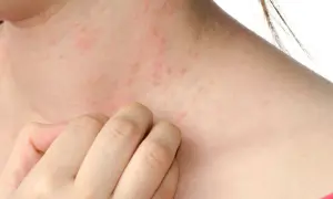 Czy cebula uczula? Objawy alergii i jak ich unikać