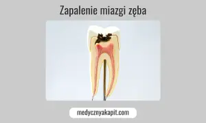 Model zęba ukazujący próchnicę i zapalenie miazgi.
