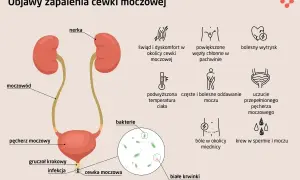 Objawy zapalenia cewki moczowej: pieczenie, ból, gorączka, krew w moczu, bolesny wytrysk. Infekcja bakteryjna cewki moczowej.