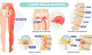 Illustrazione delle cause della sciatica: nervo sciatico, sindrome del piriforme, discopatia degenerativa, stenosi spinale ed ernia del disco.