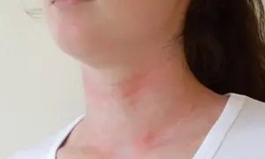 Nietolerancja Histaminy: Objawy, Przyczyny i Jak Sobie Pomóc