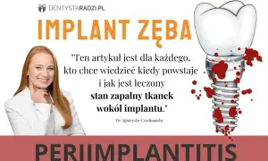 Dowiedz się, jak wyleczyć stan zapalny tkanek wokół implantu zęba. Grafika przedstawia implant zęba z krwią i uśmiechniętą dentystkę.