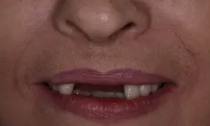 Usta z widocznymi brakami w uzębieniu, gdzie niektóre zęby są naturalne, a inne wyglądają jak złote zęby.