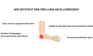 Illustration zeigt, wie **Prellungen nach Sturz** am Ellenbogen entstehen: durch Sturz auf ausgestreckten Arm, Schlag gegen harte Kante, Unfälle oder Sport.