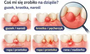 Na dziąśle pojawił się czerwony guzek, przypominający krwiak. Obrazek pokazuje różne stadia problemów z dziąsłami.