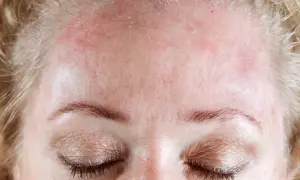 Gros plan sur le front d'une femme aux cheveux blonds, montrant une peau rouge et irritée, avec des zones de **peau qui pèle** près de la racine des cheveux.