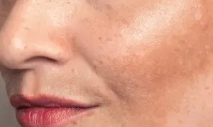 Primo piano del viso con macchie solari. La niacinamide può aiutare a ridurre le macchie solari e uniformare il tono della pelle.