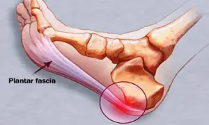 Illustration av fotens anatomi som visar plantar fascia och smärtsamma triggerpunkter vid plantar fasciitis.