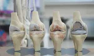 Modèles de genoux montrant l'évolution de l'arthrose et une prothèse. Ces images illustrent le succès de la prothèse du genou.