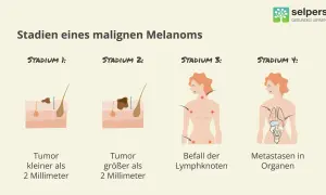 Illustrationen zeigen Stadien eines malignen Melanoms: Tumorgröße, Lymphknotenbefall und Metastasierung. Früherkennung ist wichtig für die schwarzer hautkrebs behandlung.