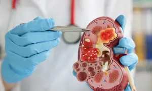 Lekarz w niebieskich rękawiczkach pokazuje model nerki z guzem, sugerując podwyższona kreatynina.