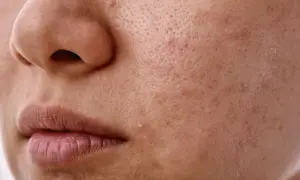 Widoczne pory skóry i drobne niedoskonałości, które mogą być związane z nadmierną produkcją sebum.