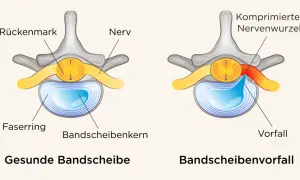 Vergleich gesunde Bandscheibe vs. Bandscheibenvorfall. Ein Vorfall drückt auf Nerven, was zu quälenden Bandscheibenvorfall Schmerzen gehen nicht weg führen kann.