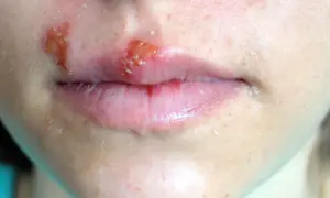 Zmiany na ustach i wokół nich, przypominające opryszczkę. Czas gojenia zależy od wielu czynników, ale zazwyczaj po jakim czasie znika afta, można zauważyć poprawę.