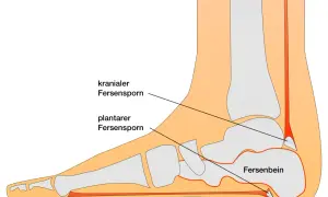 Schematische Darstellung der Calcaneus Anatomie mit Fersensporn (kranial und plantar) und dem Fersenbein.