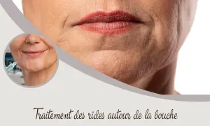Traitement des rides autour de la bouche : une injection pour un visage plus lisse.