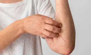 Brazo con erupción roja y picazón, posible manifestación de síntomas de estrés en la piel.