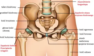 Anatomia miednicy i stawów biodrowych z zaznaczonymi strukturami kostnymi i schorzeniami.