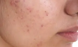 Primo piano di una guancia con evidenti brufoli e pori dilatati.