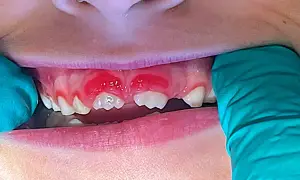 Zapalenie dziąseł u dziecka: Objawy, leczenie, kiedy do dentysty?