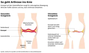Vergleich von gesundem und arthrosekrankem Kniegelenk. Die Darstellung zeigt, wie Knorpelverschleiß zu Schmerzen führt – eine mögliche "wunderwaffe gegen arthrose knie" wäre hier wünschenswert.