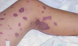Piel con manchas moradas, un posible síntoma de meningitis.
