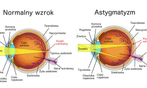 Schemat oka z normalnym wzrokiem i astygmatyzmem, pokazujący budowę i przebieg światła.