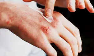 Alergia na sierść objawy skórne – jak je rozpoznać i leczyć
