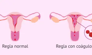 Comparación de úteros: uno muestra regla normal, el otro regla con coágulos. El embarazo y los coágulos menstruales son temas importantes.