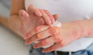 Dłonie z objawami łojotokowego zapalenia skóry, pokryte suchymi, łuszczącymi się zmianami. Osoba aplikuje krem.