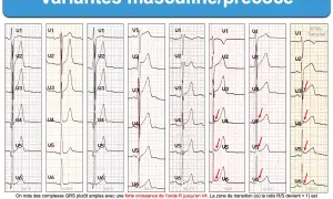 Variantes masculines/précoces : plusieurs tracés ECG montrant des variations de l'onde R et du segment ST, avec une transition précoce possible. Un ECG normal peut présenter ces caractéristiques.