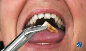 Chirurgiczne usuwanie zęba. Widok z bliska na usta, gdzie kleszcze dentystyczne trzymają wyrwany ząb, pokazując proces przesuwania się zębów po wyrwaniu.