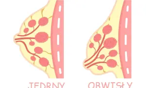 Ilustracja porównuje jędrny i obwisły biust, pokazując różnice w jego strukturze. Szukasz domowych sposobów na ujędrnienie biustu?