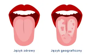 Dwa języki: zdrowy, różowy i gładki, obok języka geograficznego z plamami i nieregularnym wzorem.