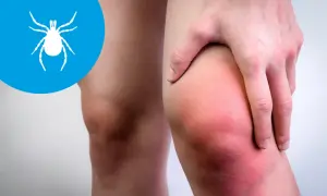 Czerwone, opuchnięte kolano z symbolem kleszcza. Może to być objaw boreliozy, a nawet neuroboreliozy.