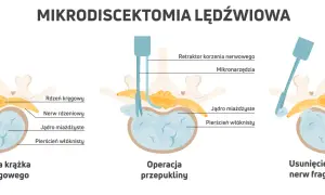 Ilustracja przedstawia etapy mikrodiscektomii lędźwiowej: przepuklinę, operację i usunięcie fragmentu krążka.
