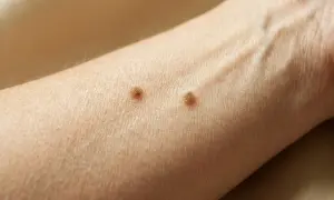 Dwie brodawki łojotokowe na przedramieniu. Ważne jest rozróżnienie ich od czerniaka.